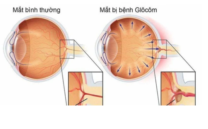 kham-va-chan-doan-benh-glocom-ban-nen-biet