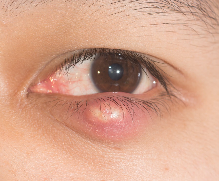 lam-the-nao-de-tu-dieu-tri-het-chap-leo