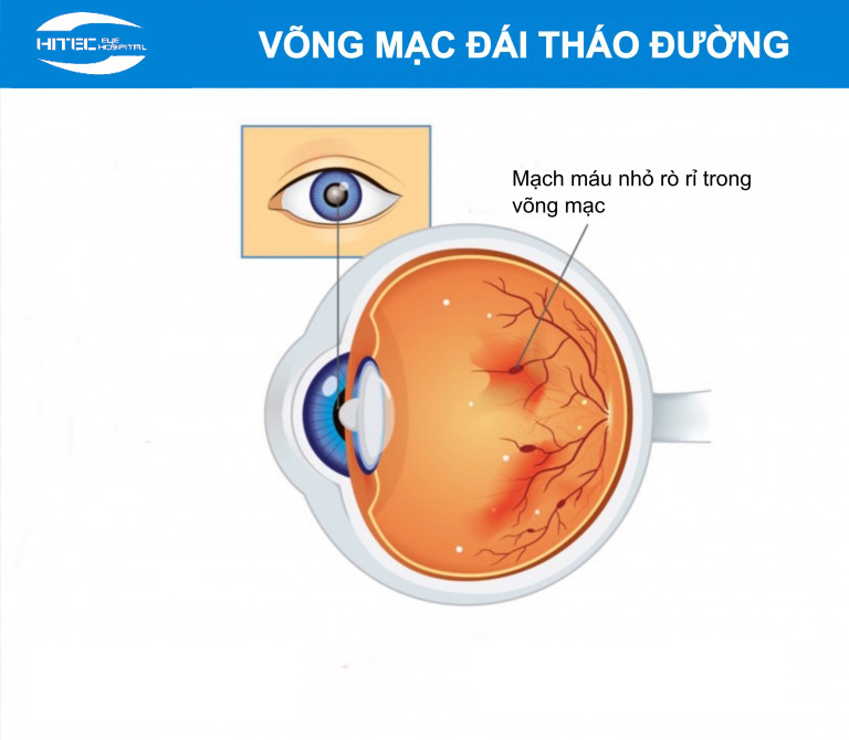 benh-vong-mac-dai-thao-duong