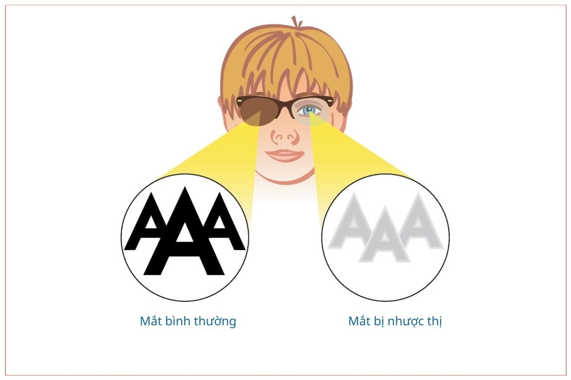 benh-nhuoc-thi-o-tre-em