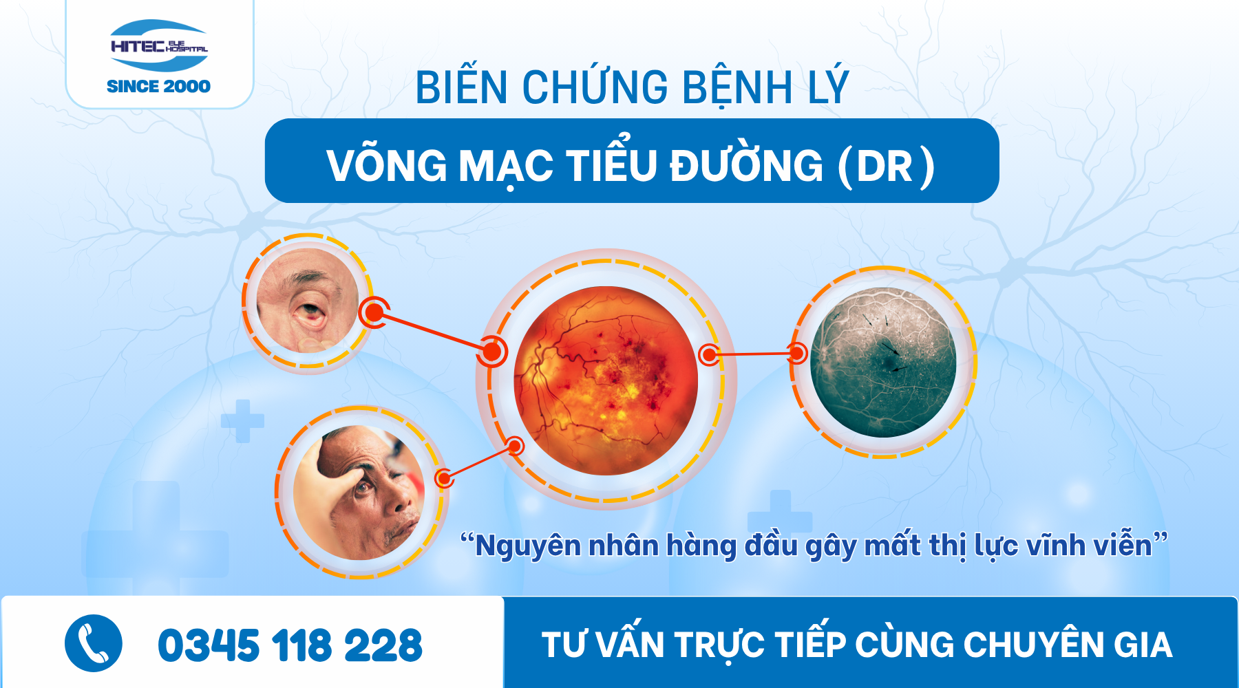 benh-ly-vong-mac-tieu-duong-dr-–-hieu-dung-de-phong-va-dieu-tri-kip-thoi